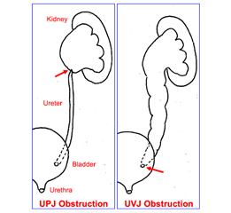 Shows two possible areas of obstruction in the urinary tract that may lead to hydronephrosis.