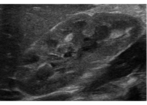 Ultrasound of a normal kidney