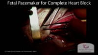 Watch: Fetal Pacemaker for Complete Heart Block.