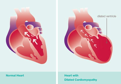 Dilated Cardiomyopathy in Children (DCM)