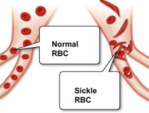 Sickle-Cell Illustration.