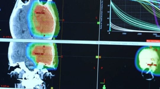 Proton Therapy: A Game Changer in Cancer Treatment