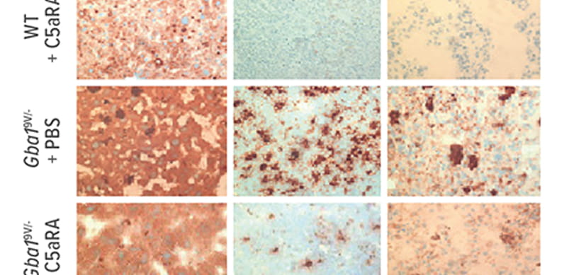 gaucher-8x4-1.jpg Targeting C5ar1 Shows Early Promise as New Therapy for Gaucher Disease