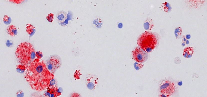 Statins Effective in Treating Pulmonary Alveolar Proteinosis