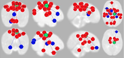How Novel MRI Methods Can Detect Cerebral Palsy in Extreme Preterm Infants