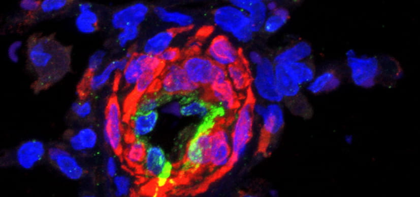 New Drug Target for a Fatal Lung Disease