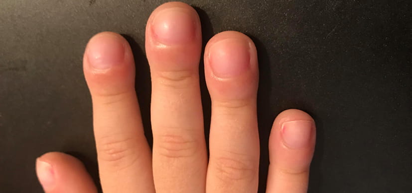 Aggressive Screening Needed to Detect sJIA Lung Complication