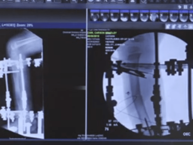 Carson’s Story: A Leg Up