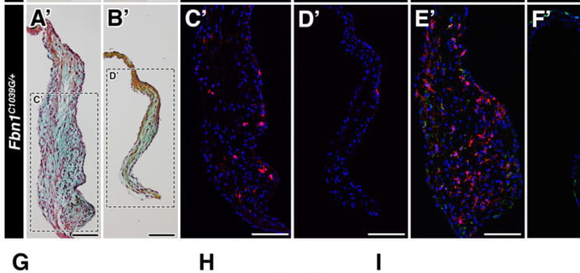 Discovery Suggests Potential Non-Surgical Option for Children, Adults with Marfan Syndrome