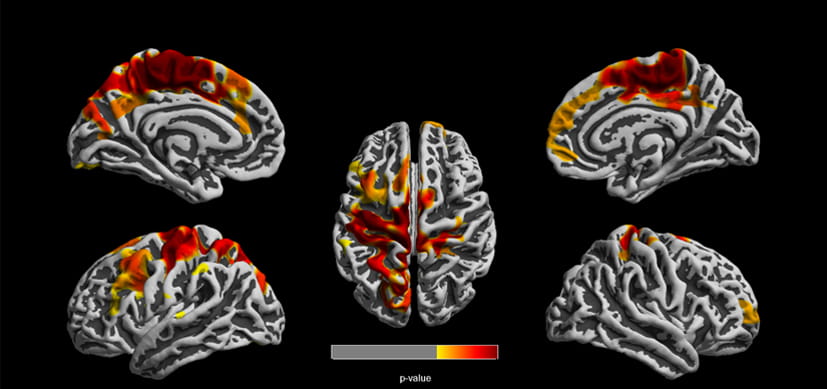 Traffic Pollution Linked to Reduced Grey Matter Development in Children