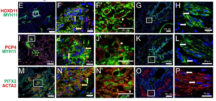Single-Cell Analysis Sheds New Light on the Rare Lung Disease LAM