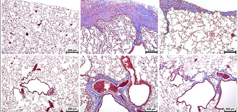 Pulmonary Fibrosis Treatment Shows Proof of Principle