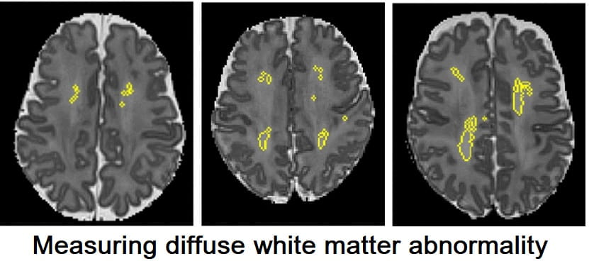 White Matter Measure Can Predict Brain Development Risk In Preterm Infants