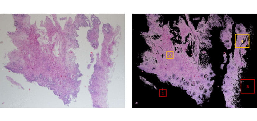 Artificial Intelligence Holds the Key to Diagnosing Rare Esophageal Food Allergy Disease