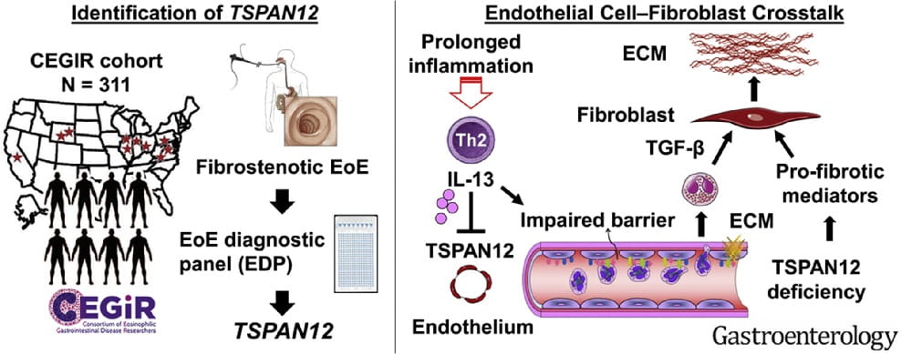 TSPAN12 Gene Plays Central Role in Fibrosis Development Among Some People with EoE