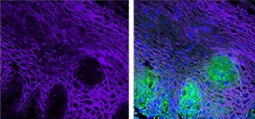 Two Genes Associated with Familial EoE
