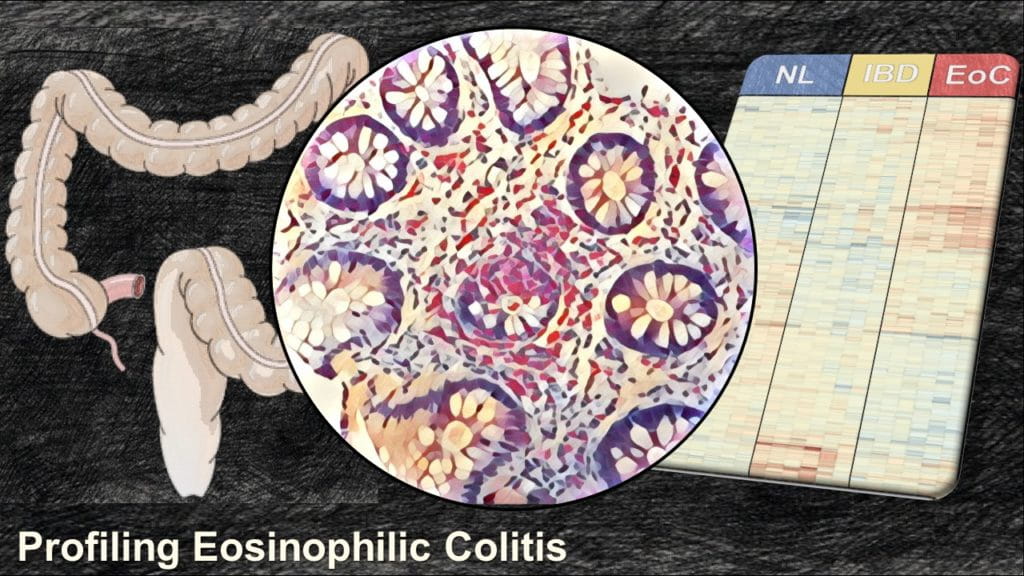 Molecular Analysis Suggests Eosinophilic Colitis is a Unique Disease