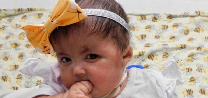 Surgery for a Child with Trisomy 18