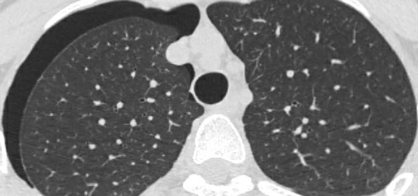 Is Your Hospital Prepared to Treat Vaping-Related Lung Injuries?