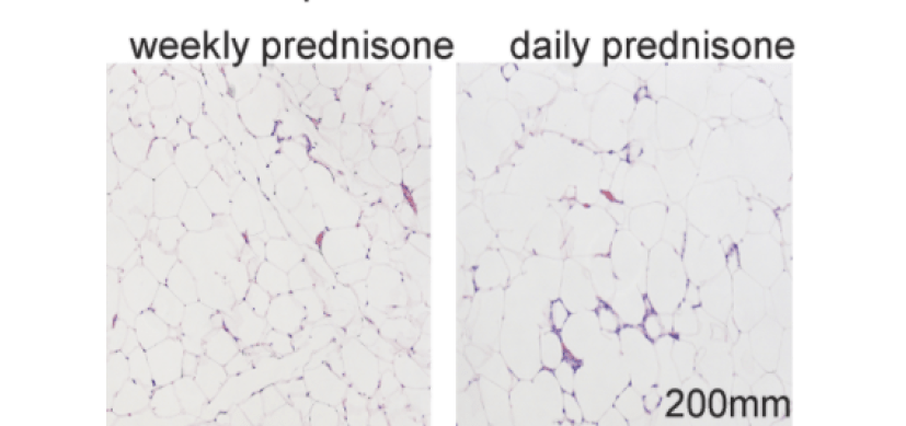 Obesity and Prednisone: Weekly Dose ‘Strikingly Different’ Outcomes vs. Daily