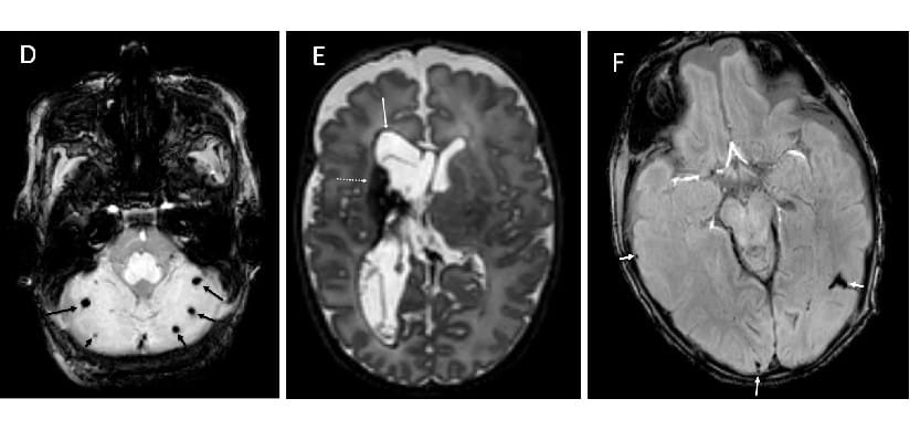 Chorioamnionitis Directly Harms the Brains of Very Preterm Infants
