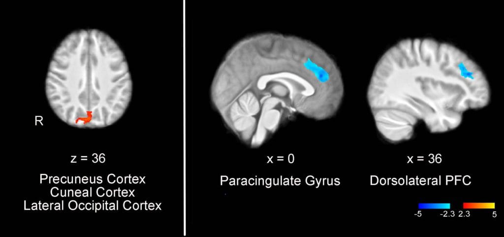 15-Site Trial to Compare Telehealth Cognitive Behavior Therapy Alone and with Medication to Prevent Migraine in Youth