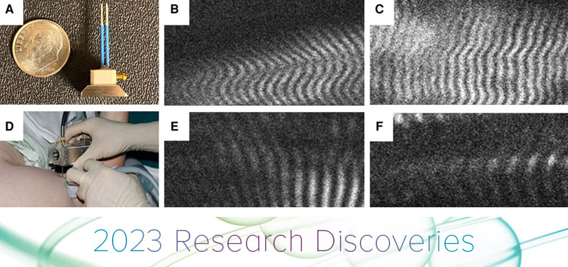 Identifying a Common Contracture Phenotype for BPBI and CP