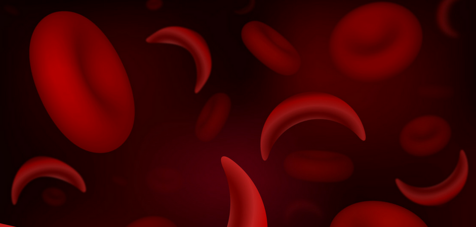 sickle.png Hydroxyurea Research Gets $7.7M Boost from NHLBI