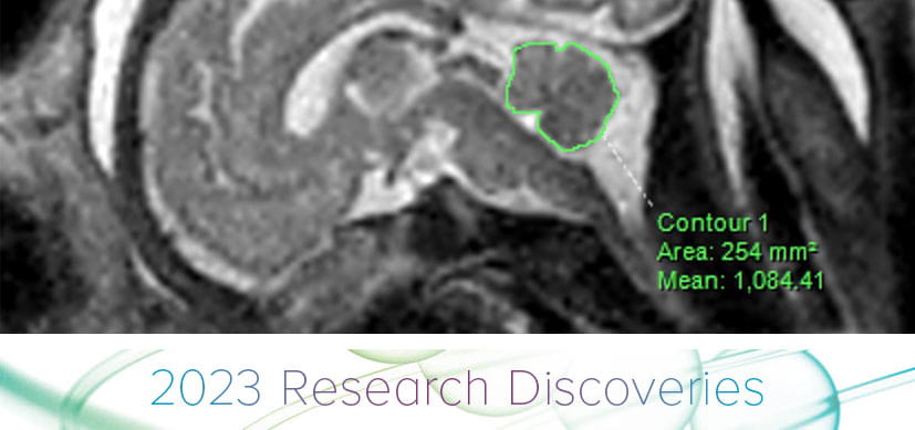 In Utero Opioid Exposure Impacts Fetal Brain Size and Development