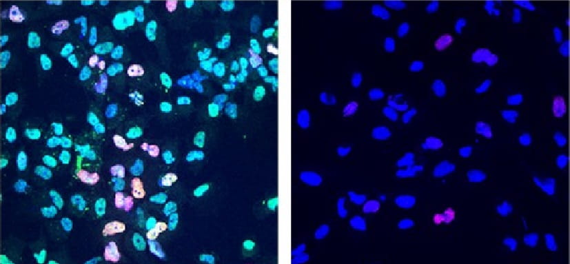 Druggable Targets Found for Treating Rare, Deadly Nerve Cancer MPNST