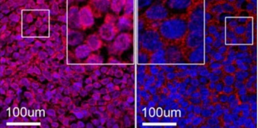 Ewing Sarcoma Tumors Can Be Split Into 2 Groups for Targeted Care