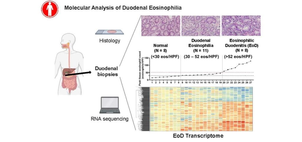 Characterizing Eosinophilic Duodentitis