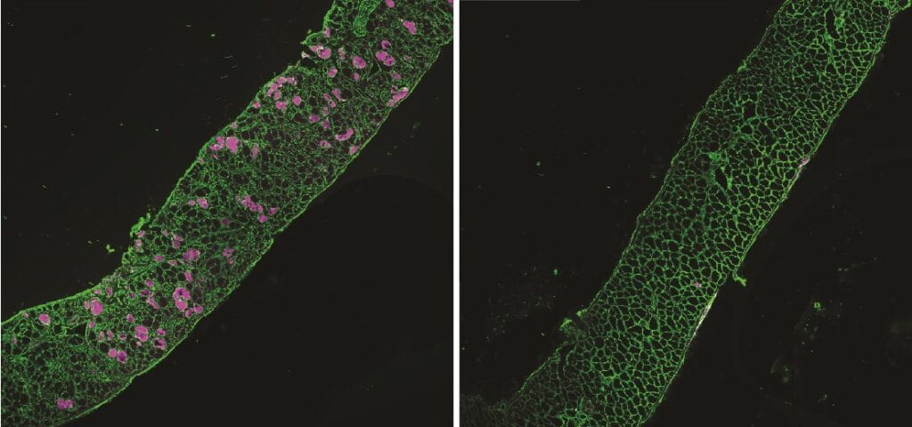 Bold New Therapy Delivery Method Shows Initial Promise as Treatment for Duchenne Muscular Dystrophy