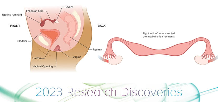 Müllerian Agenesis: Room for Improvement in Care, Counseling