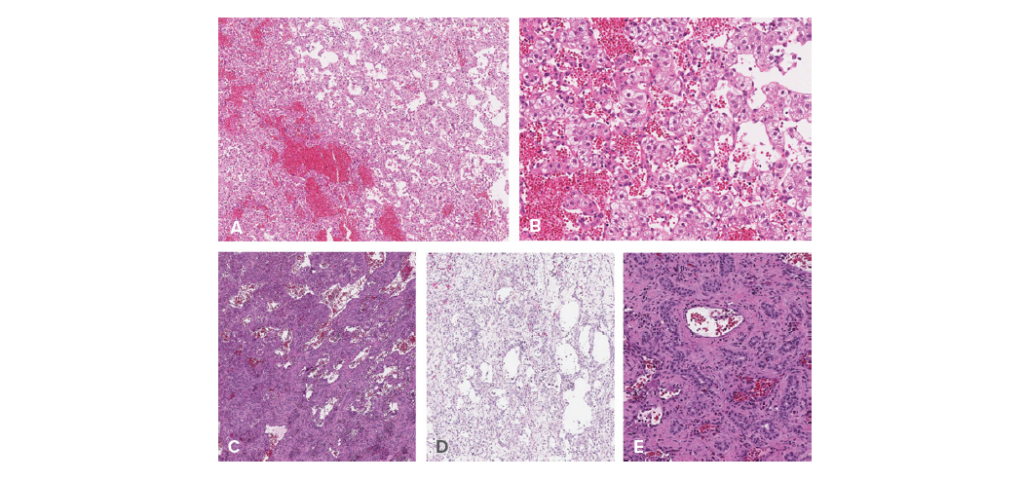 Updated Classification of Pediatric Hepatic Vascular Tumors