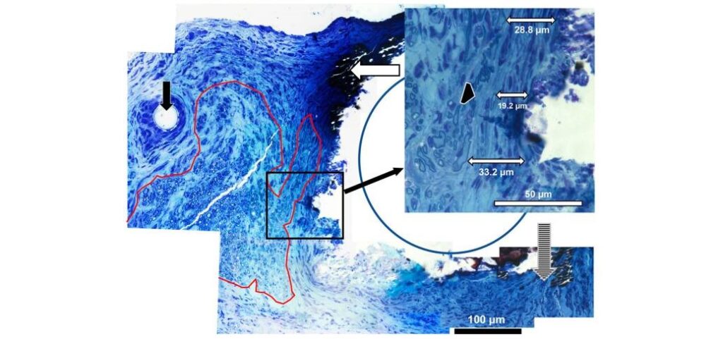 Zinc-Iron Alloy Shows Promise in Nerve Repair