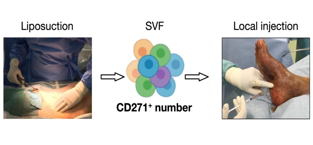 Novel Approach Emerging for Rescuing Limbs at Risk