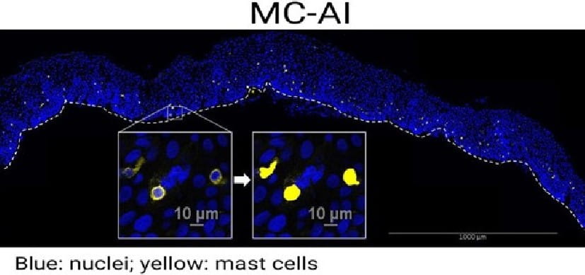 Artificial Intelligence Assists Expanded Hunt for Cells Driving Eosinophilic Esophagitis