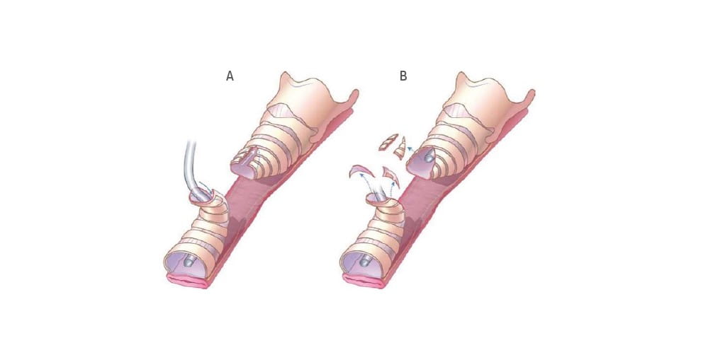 Versatility of Slide Tracheoplasty
