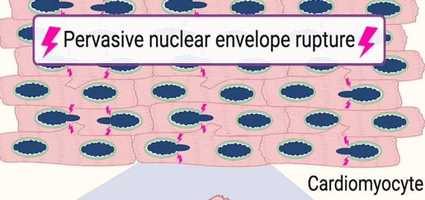 DCM-study-image-THUMB.jpg Study Challenges Current Thinking About Mechanisms of Dilated Cardiomyopathy