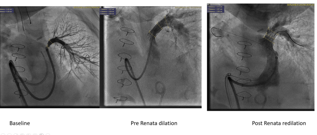 Novel Heart Stent for Kids Draws Praise