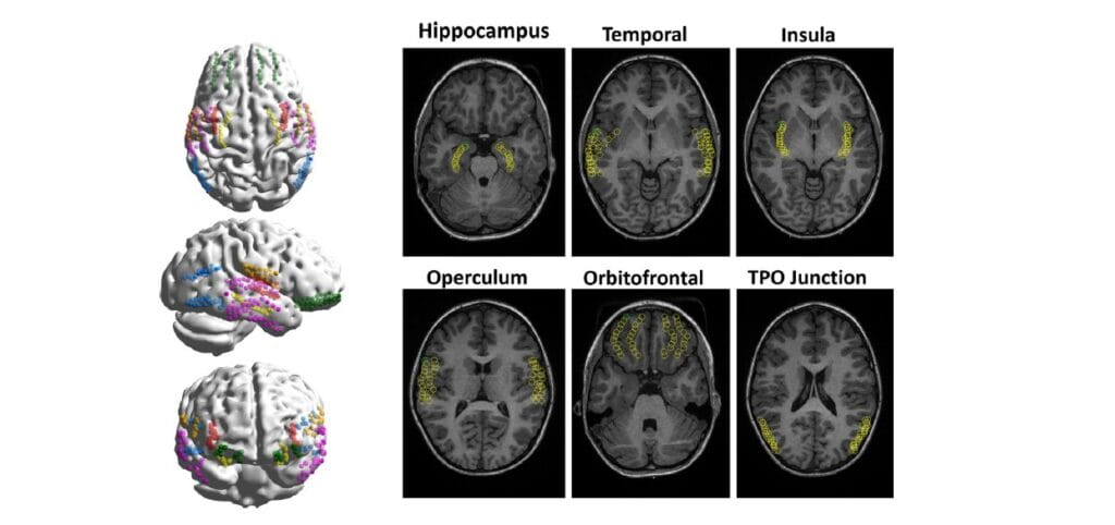 Beamforming Technique May Improve Epilepsy Surgery Outcomes