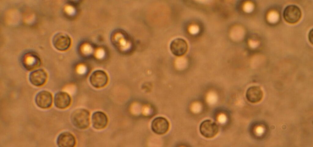 Requiring Pyuria for UTI Diagnosis May Miss Infections