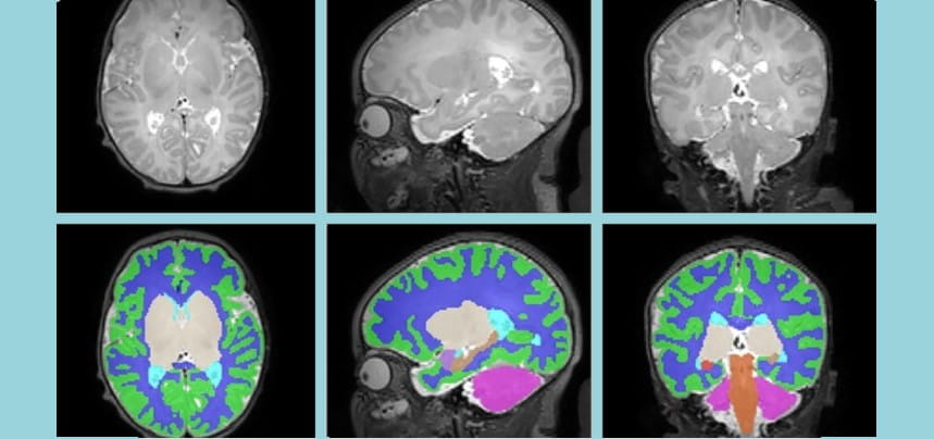 Newborn Brains Are Smaller When Exposed to Opioids During Gestation