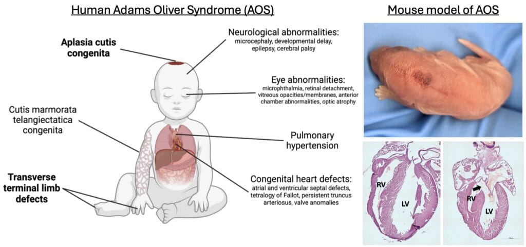 Genetic Research Pinpoints a Lethal Risk Linked to Adams-Oliver Syndrome