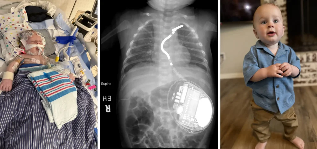 Speed, Expertise and Advanced Technology Combine to Save an Infant’s Heart