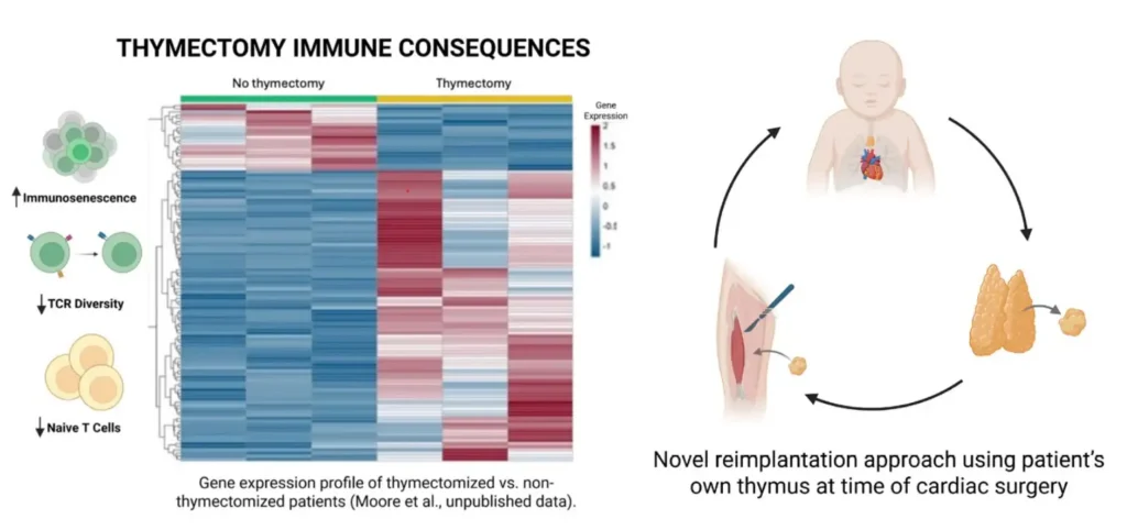 Could Thymic Reimplantation Help Children Stay Healthier After Heart Surgery?