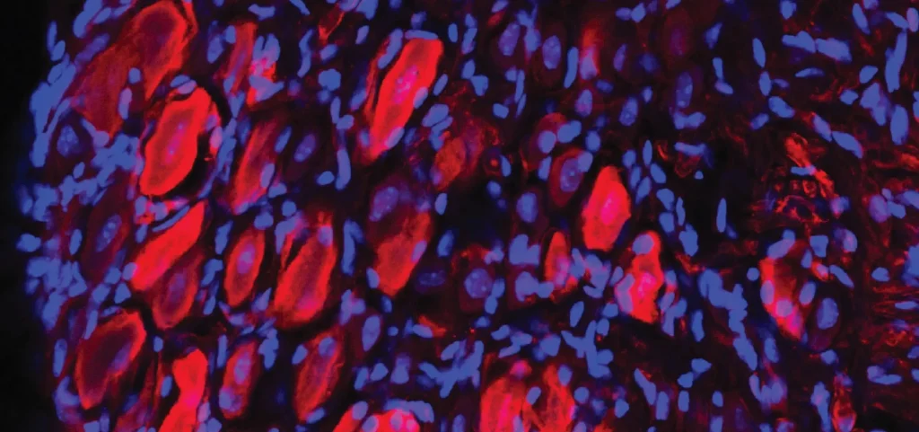 Preventing Schwann Cells from Producing GDNF May Reduce NF1 Pain