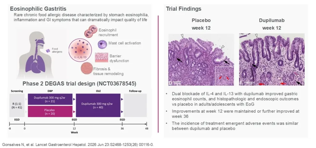 Dupilumab Improves Outcomes for EoG in Phase 2 Clinical Trial