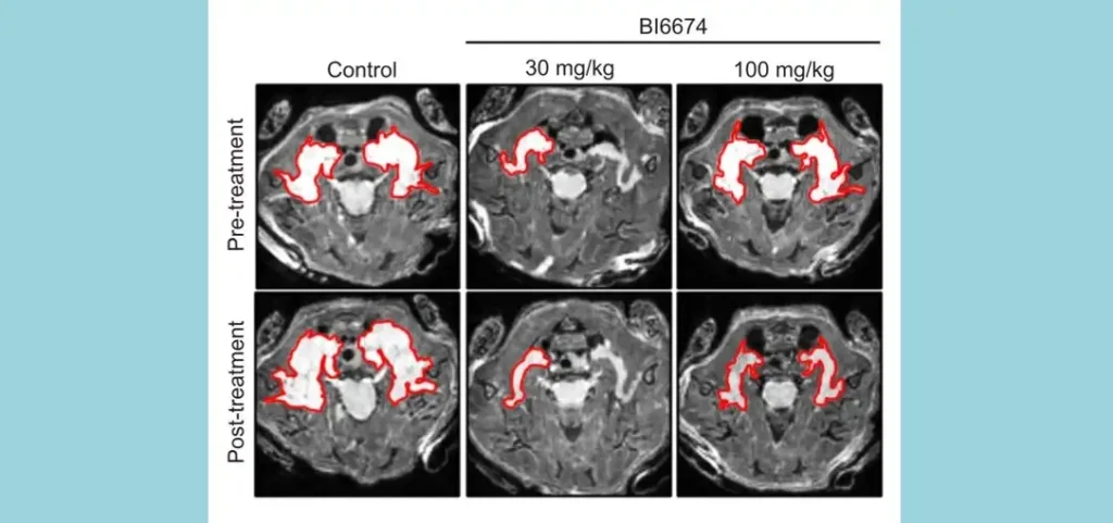New class of KRAS Inhibitors Shows Promise at Shrinking NF1 Nerve Tumors